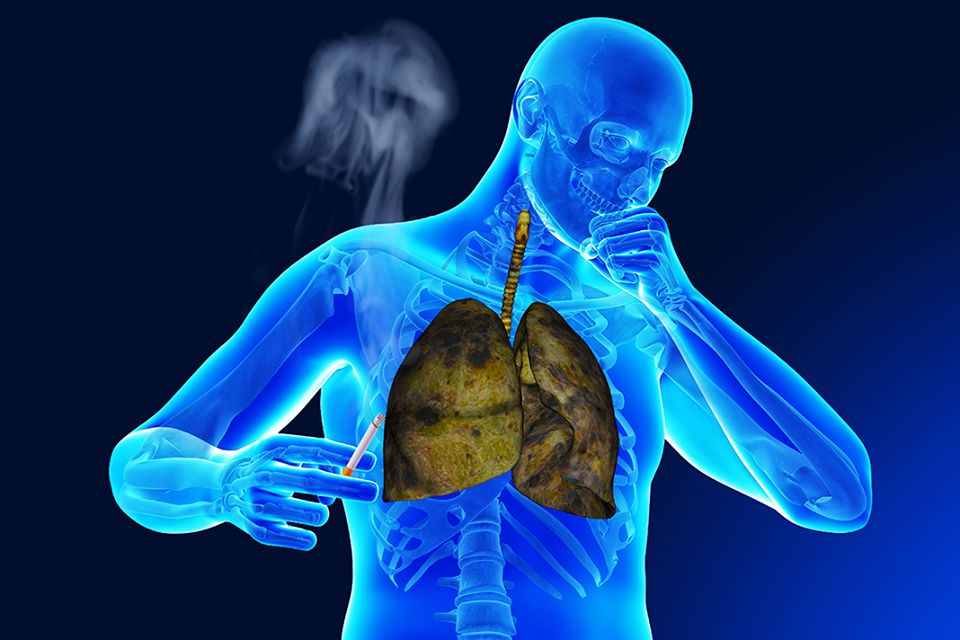 Những điều cần biết về triệu chứng của bệnh lao phổi